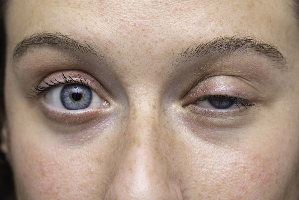 Mujer con un ojo con ptosis